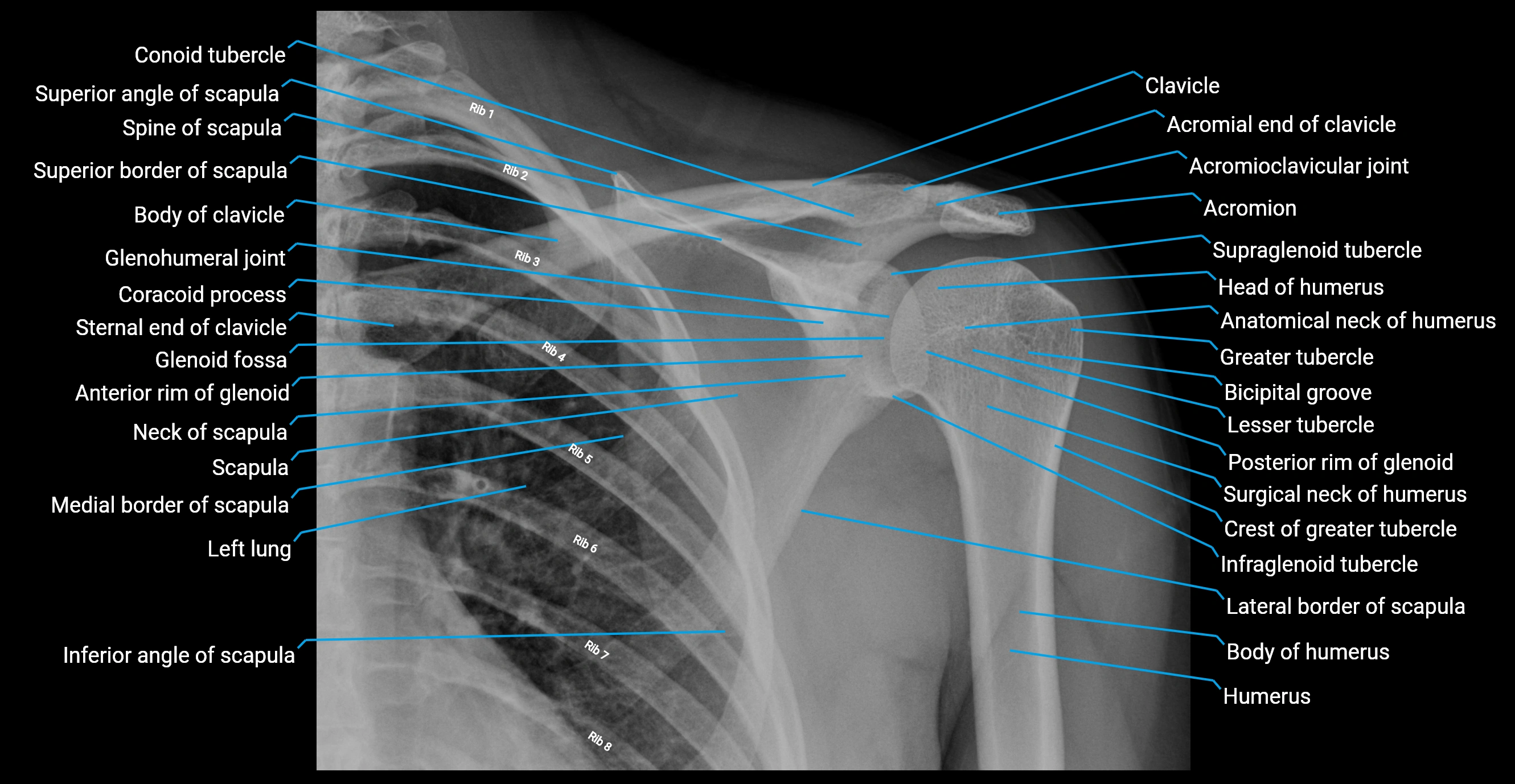 x ray  shoulder AP anatomy labelled image.webp